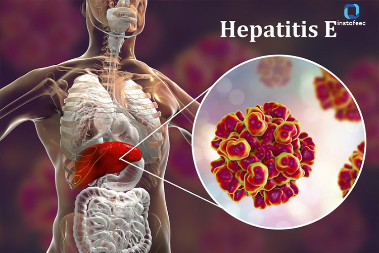 Monsoon Health Alert: Understanding and Preventing Hepatitis E